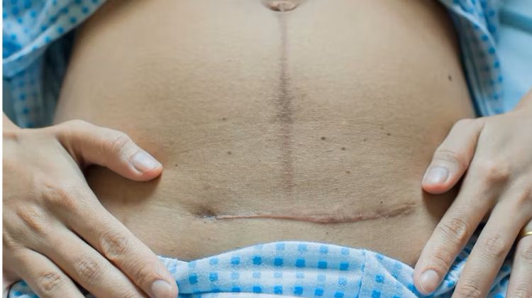 Preparing for a Planned C-Section